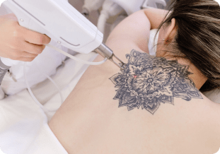 Laser Tattoo Removal